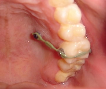 درمان لق شده گی دندان یا اسپلینت